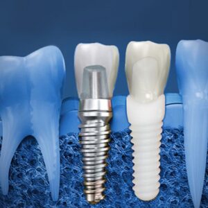 implant-cerrahisi Implant Surgery