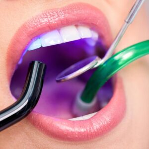 lazerle-dolgu Laser Filling